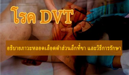 โรค DVT อธิบายภาวะหลอดเลือดดำส่วนลึกที่ขา และวิธีการรักษา